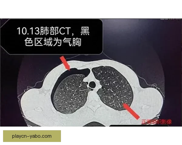坎宁安气胸恢复顺利 活塞官方公布复查时间和复出计划 坎宁安气胸恢复顺利 活塞官方公布复查时间和复出计划
